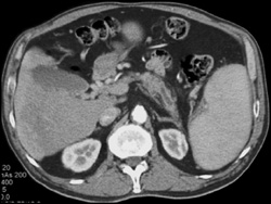 Pancreatic Cancer With Dilated Pancreatic Duct - CTisus CT Scan