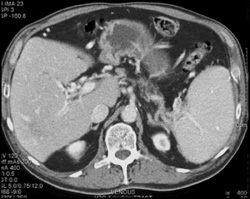 Collaterals in Porta Following Pancreatitis - CTisus CT Scan