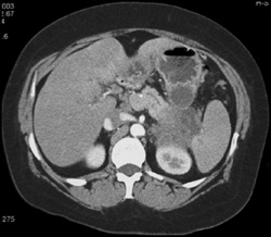 Pancreatic Cancer With Liver Metastases - CTisus CT Scan