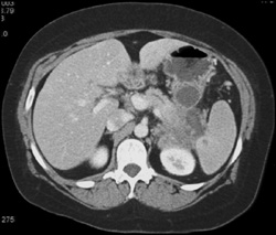 Pancreatic Cancer With Liver Metastases - CTisus CT Scan