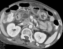 Chronic Pancreatitis - CTisus CT Scan