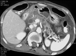 Chronic Pancreatitis - CTisus CT Scan