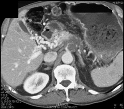 Pancreatitis and Secondary Cavernous Transformation of the Portal Vein (CTPV) - CTisus CT Scan