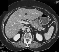 Pancreatic Cancer - CTisus CT Scan