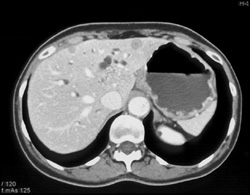 Pancreatic Cancer With Liver Metastases - CTisus CT Scan