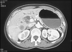 Pancreatic Cancer With Liver Metastases - CTisus CT Scan