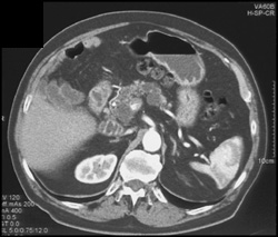 Intraductal Papillary Mucinous Neoplasm (IPMN) Infiltrates the Entire Gland - CTisus CT Scan