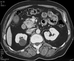 Multiple Intraductal Papillary Mucinous Neoplasms (IPMNs) - CTisus CT Scan