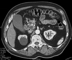 Multiple Intraductal Papillary Mucinous Neoplasms (IPMNs) - CTisus CT Scan