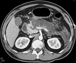 Acute Pancreatitis - CTisus CT Scan