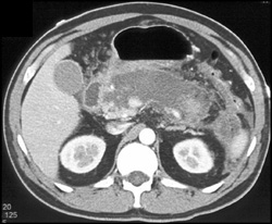 Acute Pancreatitis - CTisus CT Scan