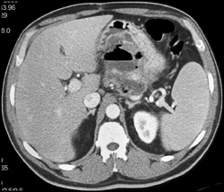 Pancreatic Abscess - CTisus CT Scan