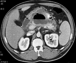 Pancreatic Abscess - CTisus CT Scan