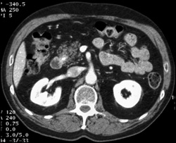 Stone in Distal Common Bile Duct (CBD) With Fatty Pancreas - CTisus CT Scan