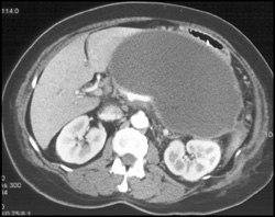 Pseudocyst - CTisus CT Scan