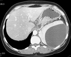 Pseudocyst Extends Beneath Splenic Capsule - CTisus CT Scan