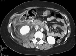 Post ERCP Pancreatitis Involves the Perirenal Space on the Right - CTisus CT Scan