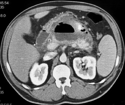 Pancreatic Abscess - CTisus CT Scan