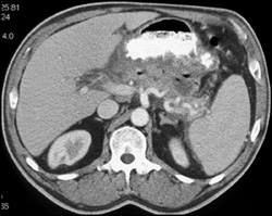 Pancreatic Abscess - CTisus CT Scan