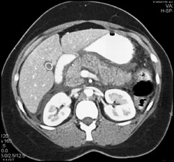 Acute Pancreatitis - CTisus CT Scan