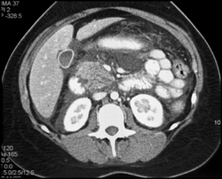 Acute Pancreatitis - CTisus CT Scan