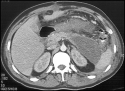 Pancreatitis With Pseudocyst - CTisus CT Scan