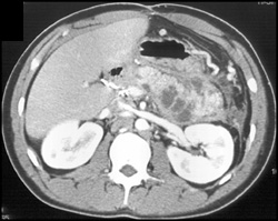 Pancreatic Necrosis With Occluded Splenic Vein - CTisus CT Scan