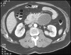 Pseudocyst Tracks Behind Duodenum - CTisus CT Scan