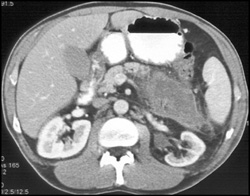 Acute Pancreatitis - CTisus CT Scan