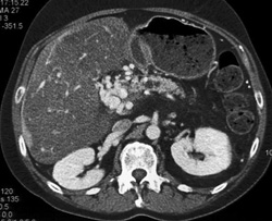 Chronic Pancreatitis With Cavernous Transformation of the Portal Vein (CTPV) - CTisus CT Scan