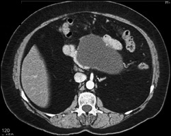 Pseudocyst - CTisus CT Scan