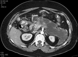 Necrotizing Pancreatitis - CTisus CT Scan