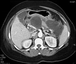 Acute Pancreatitis - CTisus CT Scan