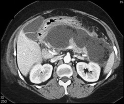 Acute Pancreatitis With Pseudocysts - CTisus CT Scan