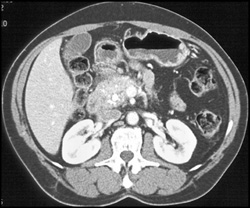 Acute Pancreatitis - CTisus CT Scan