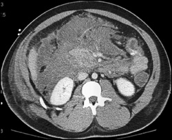 Extensive Pancreatitis and Fluid in Mesentery - CTisus CT Scan