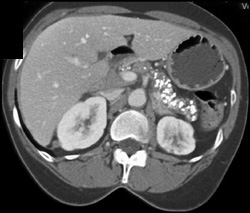 Chronic and Acute Pancreatitis - CTisus CT Scan