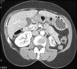 Chronic Pancreatitis - CTisus CT Scan