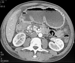 Chronic Pancreatitis - CTisus CT Scan