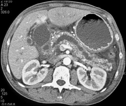 Chronic Pancreatitis With Dilated Pancreatic Duct - CTisus CT Scan