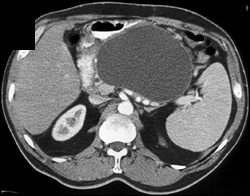 Pseudocyst - CTisus CT Scan