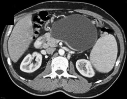 Pseudocyst - CTisus CT Scan