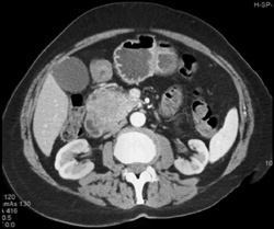 Gastroduodenal Artery (GDA) Pseudoaneurysm Due to Pancreatitis - CTisus CT Scan