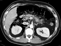 Air Near Pancreas S/P ERCP With Perforation - CTisus CT Scan