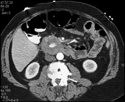 Gastroduodenal Artery (GDA) Pseudoaneurysm - CTisus CT Scan