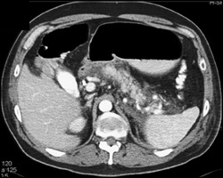 Acute Pancreatitis - CTisus CT Scan