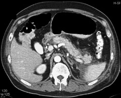 Acute Pancreatitis - CTisus CT Scan