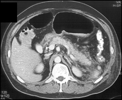 Acute Pancreatitis - CTisus CT Scan