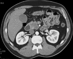 Pancreatic Cancer - CTisus CT Scan