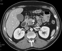 Pancreatic Cancer - CTisus CT Scan